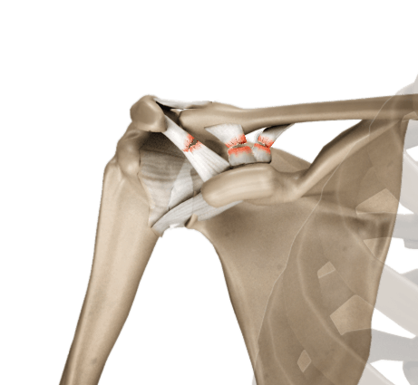 AC Joint Separation