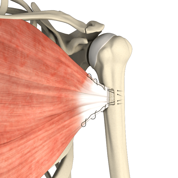 Pectoralis Repair