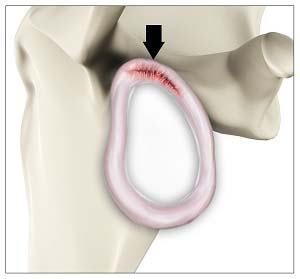 Labral SLAP Tear 