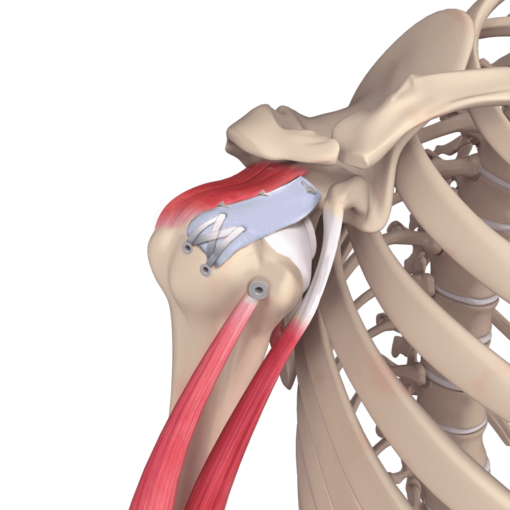 Superior Capsule Reconstruction